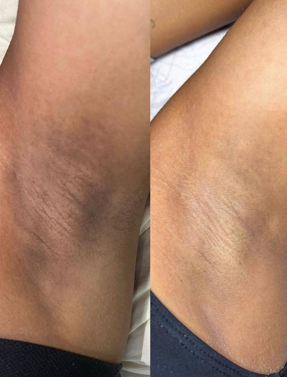 Before and after laser hair removal underarm results — dark skin tone treatment at American Laser Plus