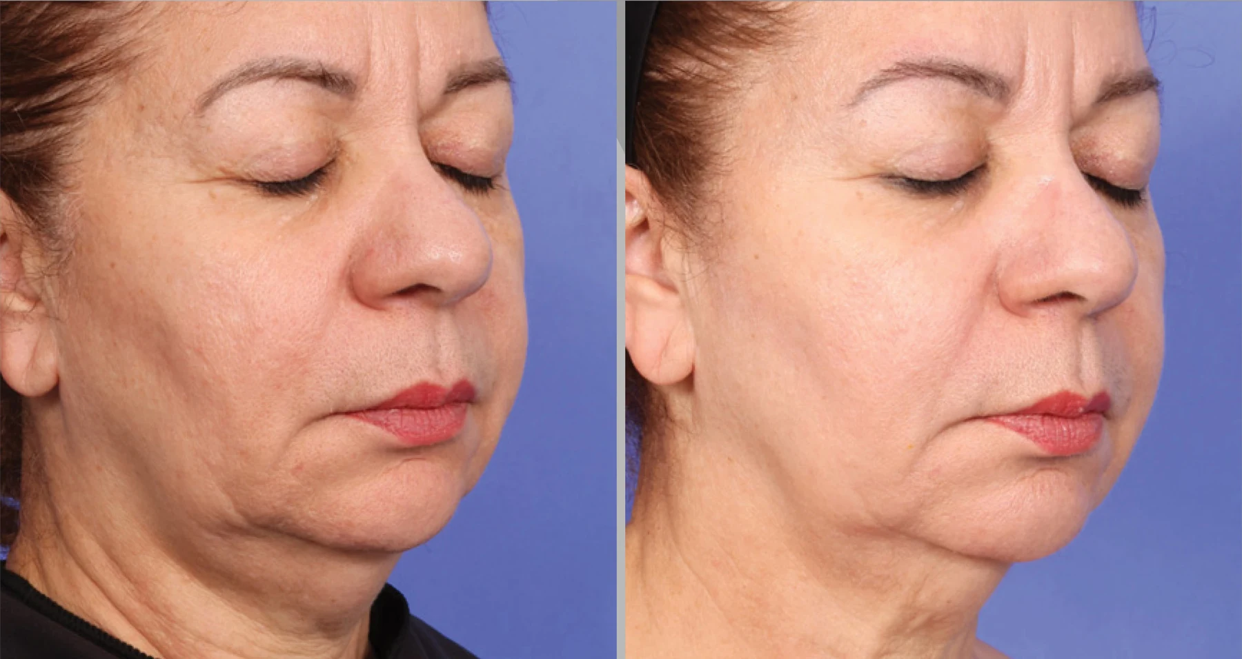 XERF clinical before and after photographs, one treatment · profile
