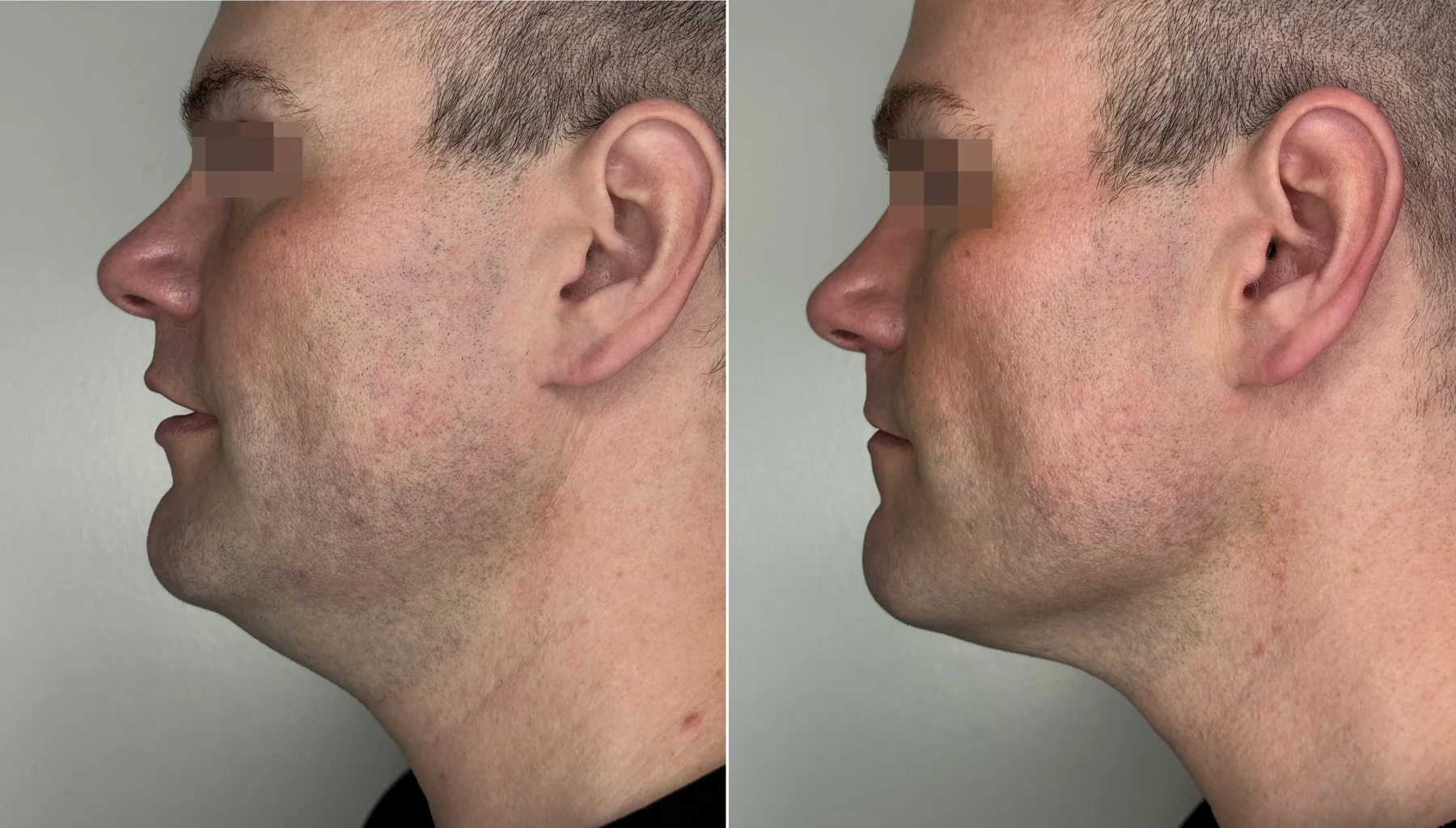 XERF clinical before and after photographs, two months after two treatments