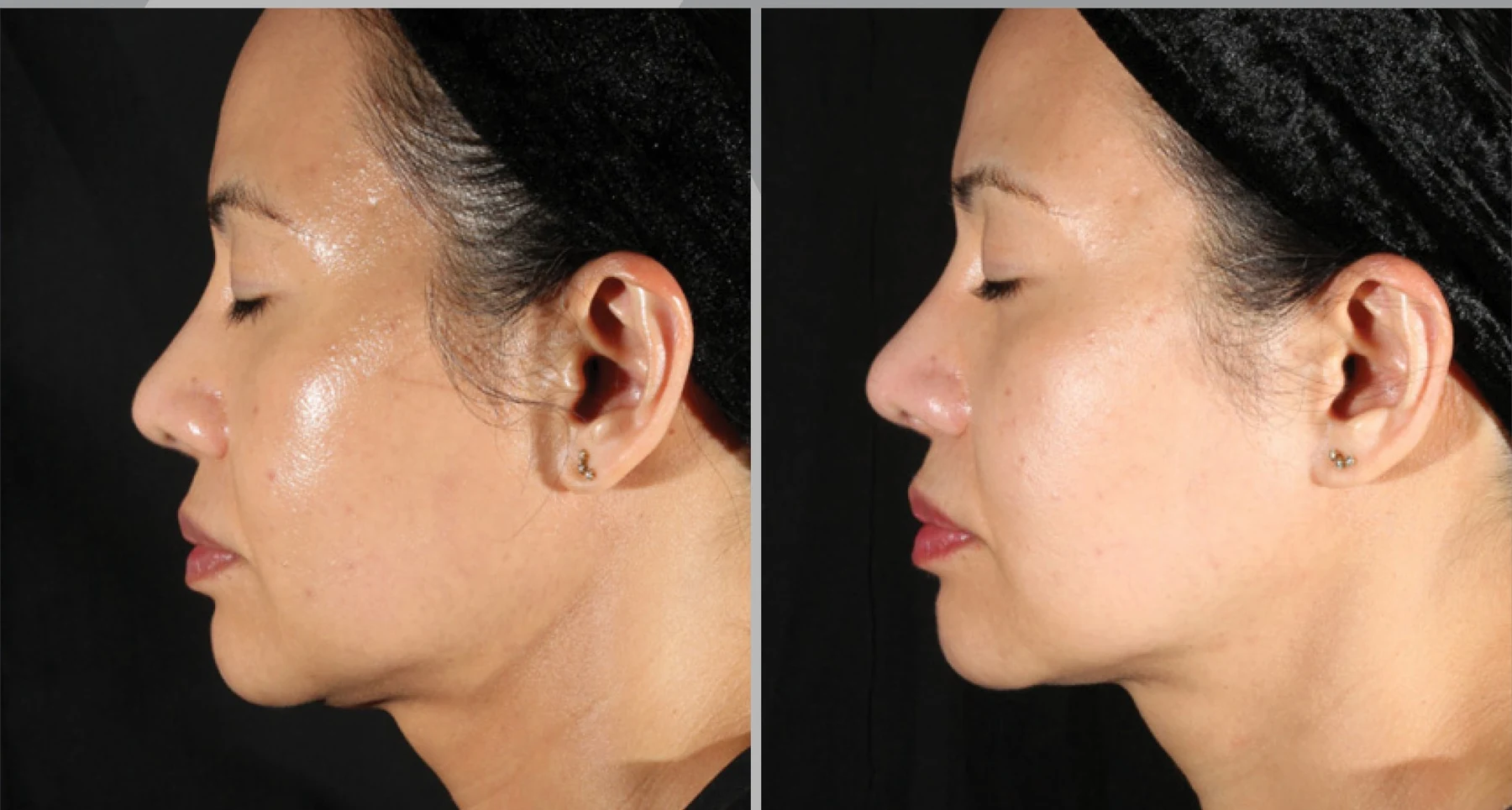 XERF clinical before and after photographs, one treatment