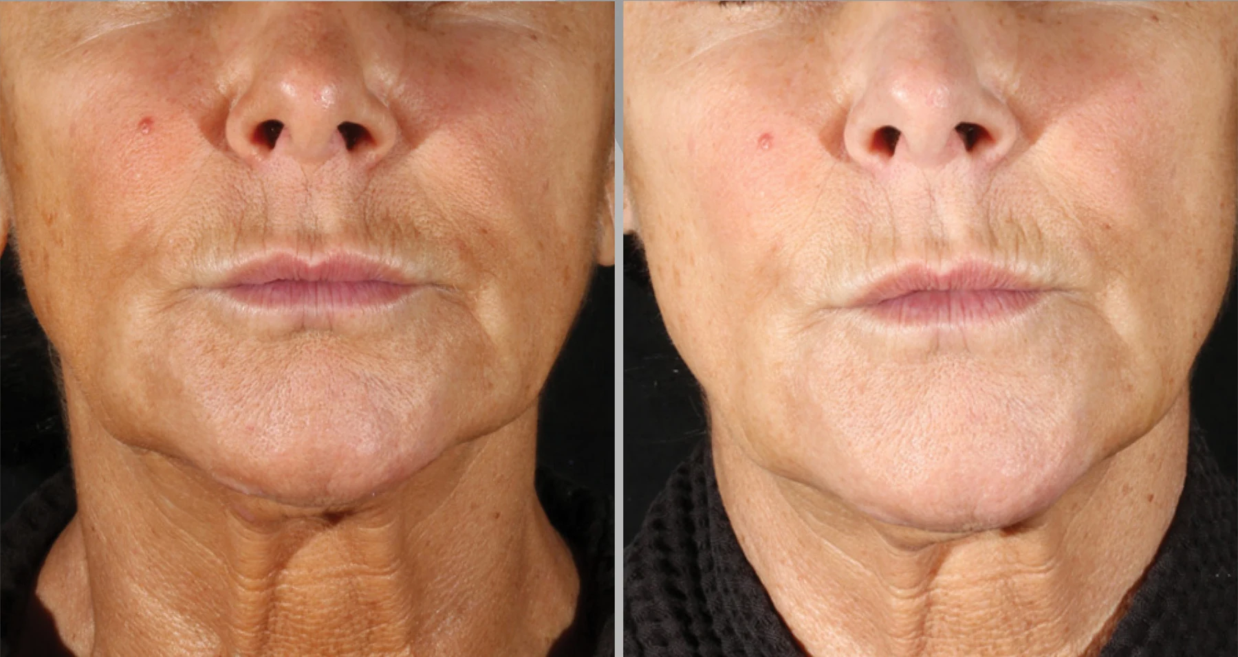 XERF clinical before and after photographs, two treatments · front view