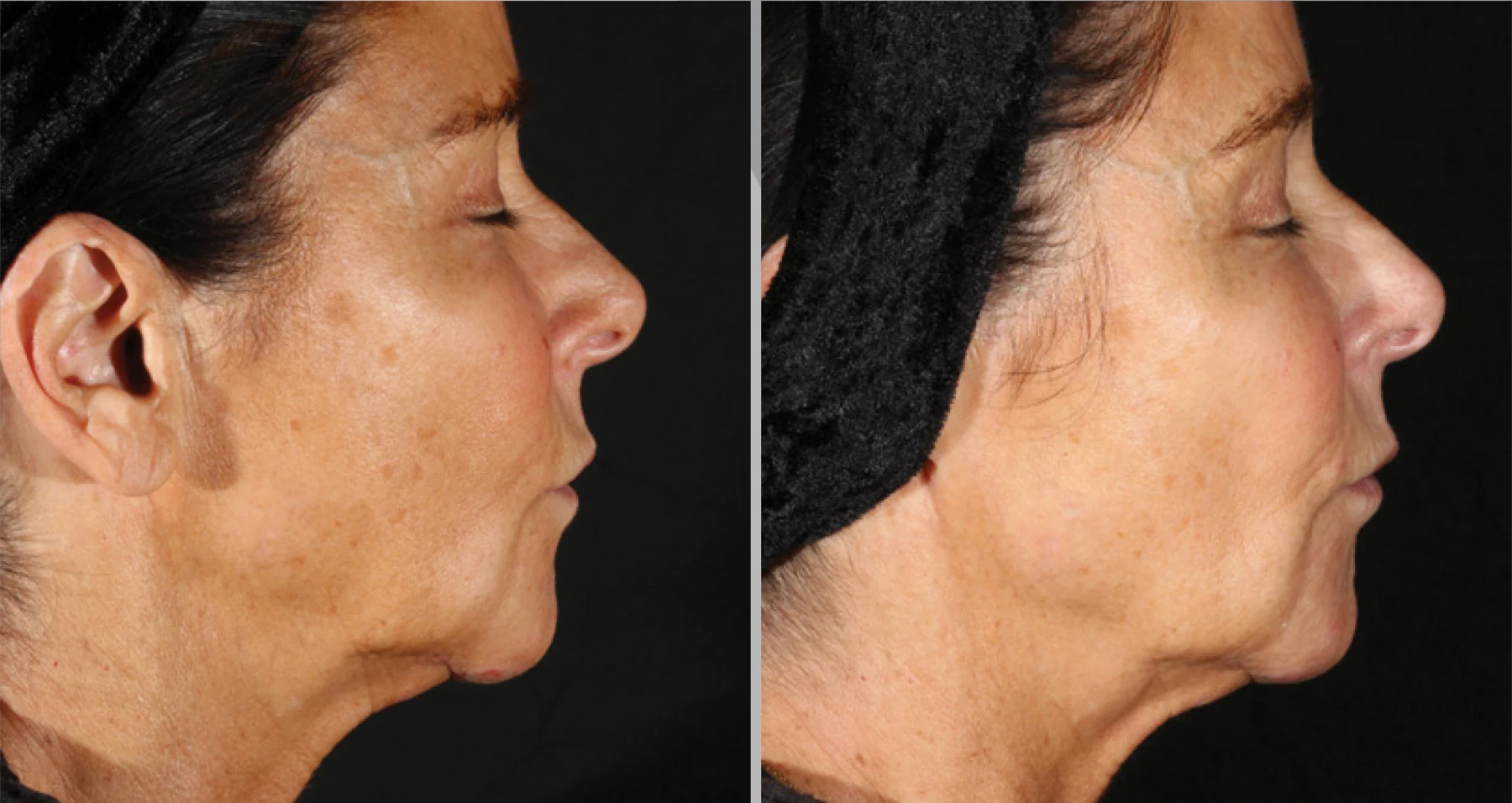 XERF clinical before and after photographs, one treatment · profile