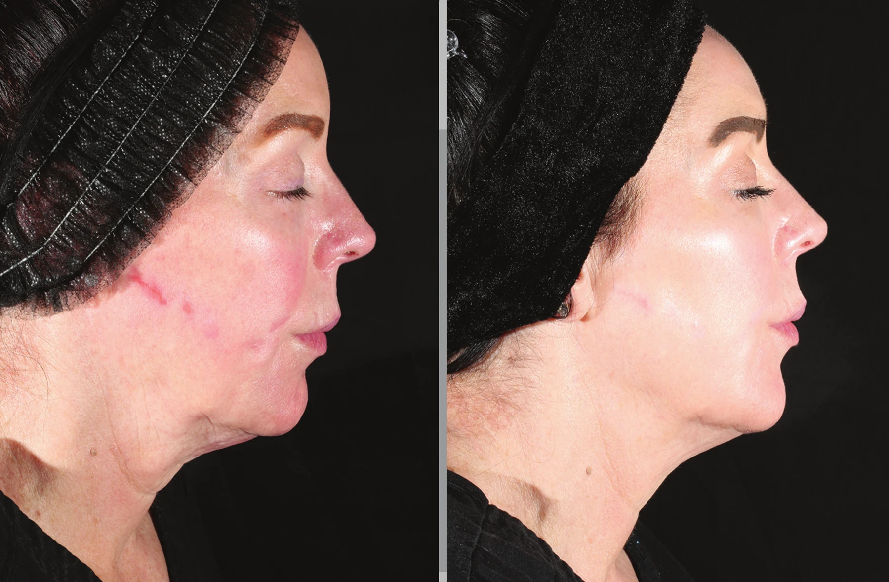 XERF clinical before and after photographs, two treatments · profile