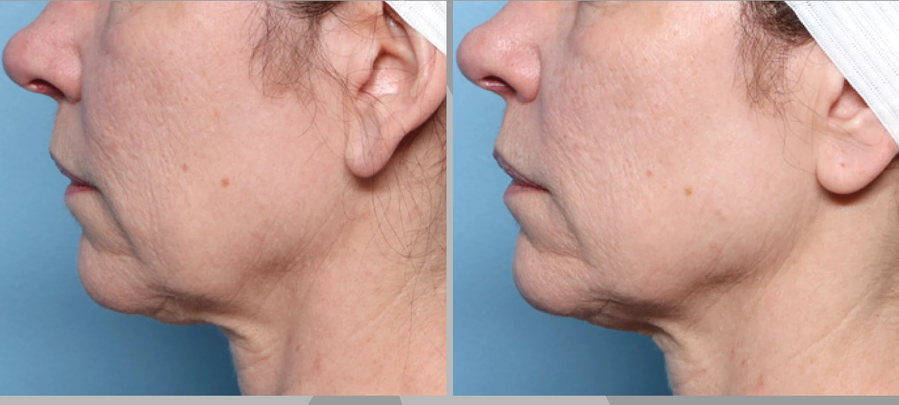 XERF clinical before and after photographs, two treatments